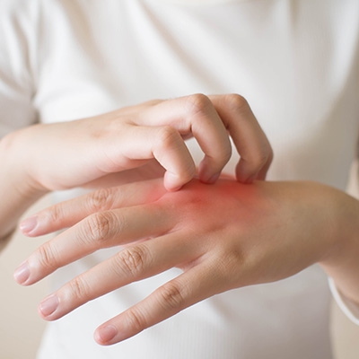 Como os probi&oacute;ticos ajudam quem sofre de eczema?